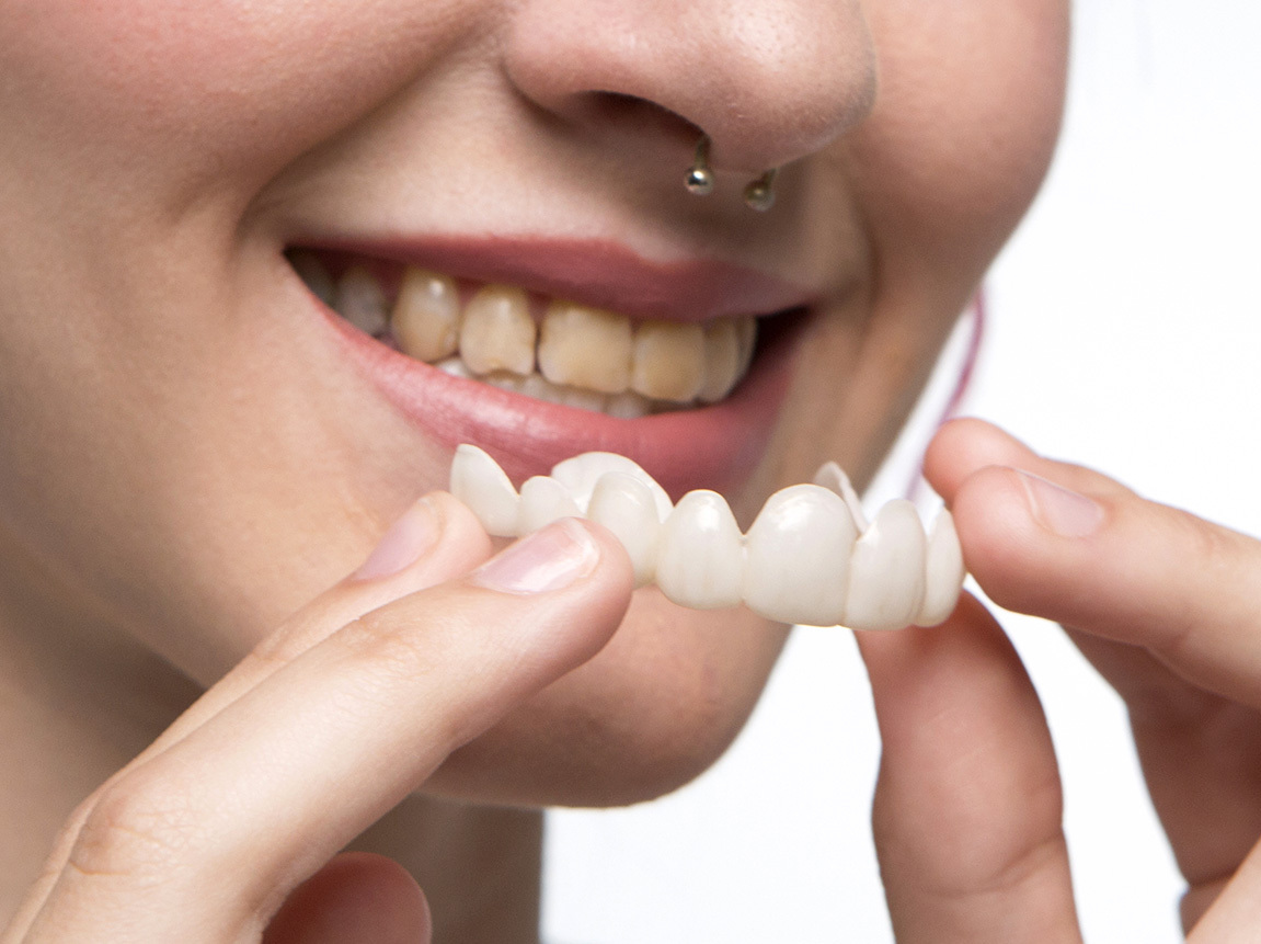 Unlock Your Dream Smile Instantly: Why Instasmile Snap-On Veneers Are the Game-Changer Everyone’s Talking About in 2026